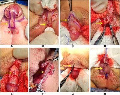 The effect of staged TIP urethroplasty on proximal hypospadias with severe chordee